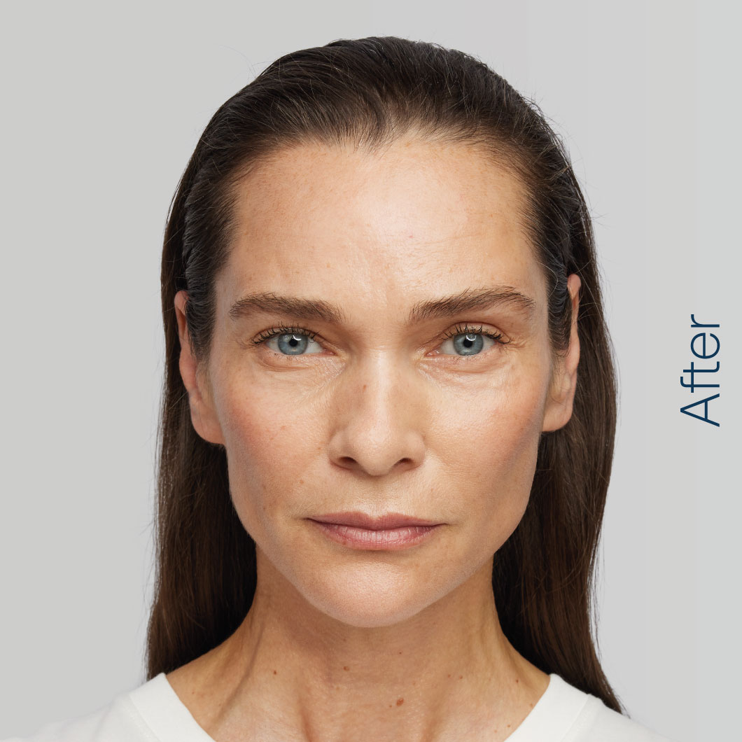 Patient after RADIESSE.