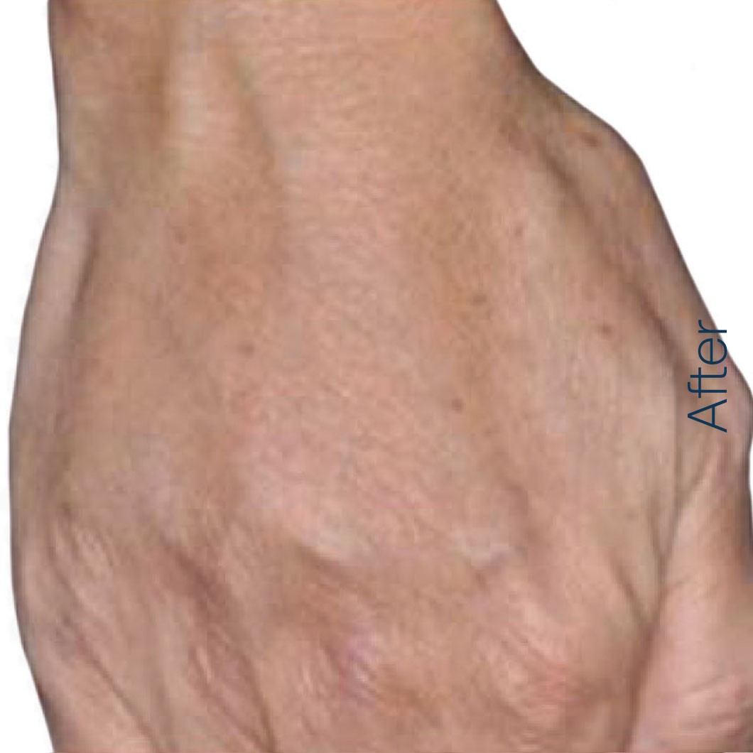 Hand after RADIESSE.