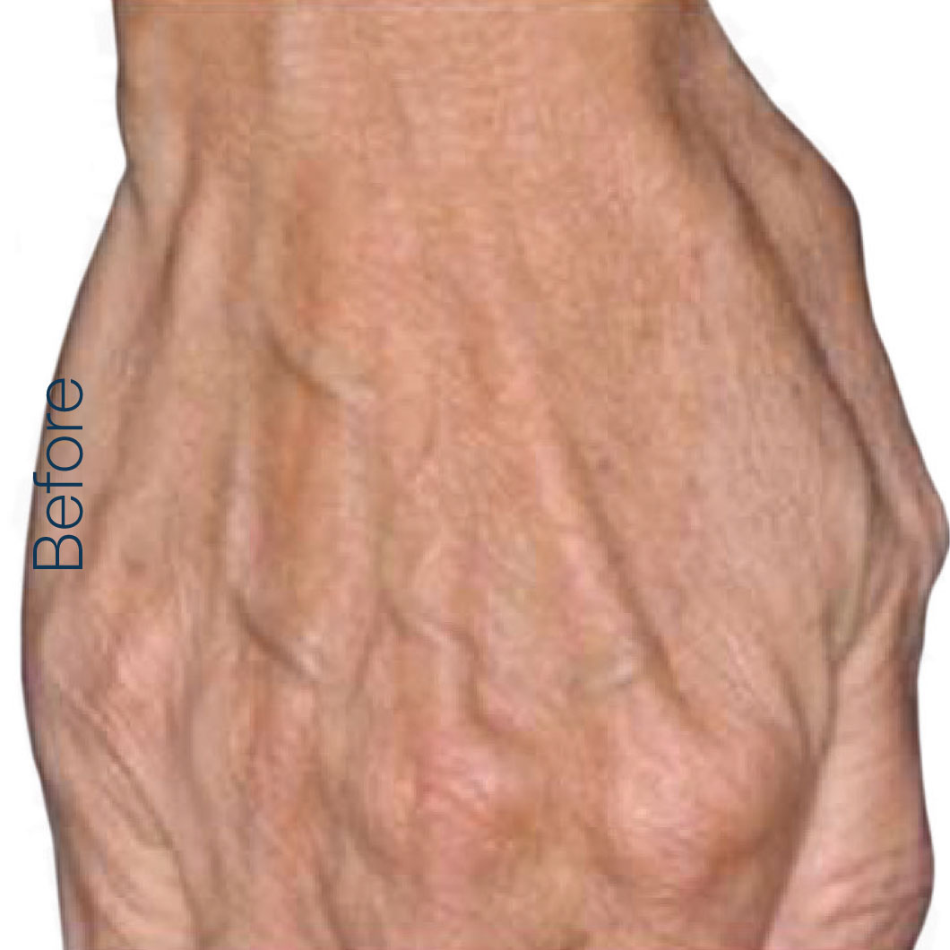 Hand before RADIESSE.